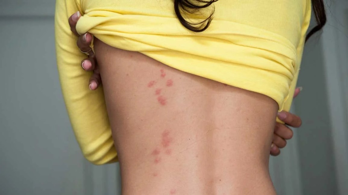 bed bug bites