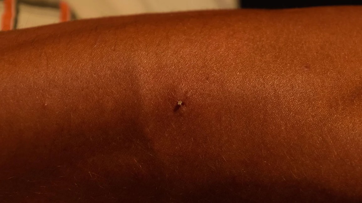 bee sting with stinger left in skin