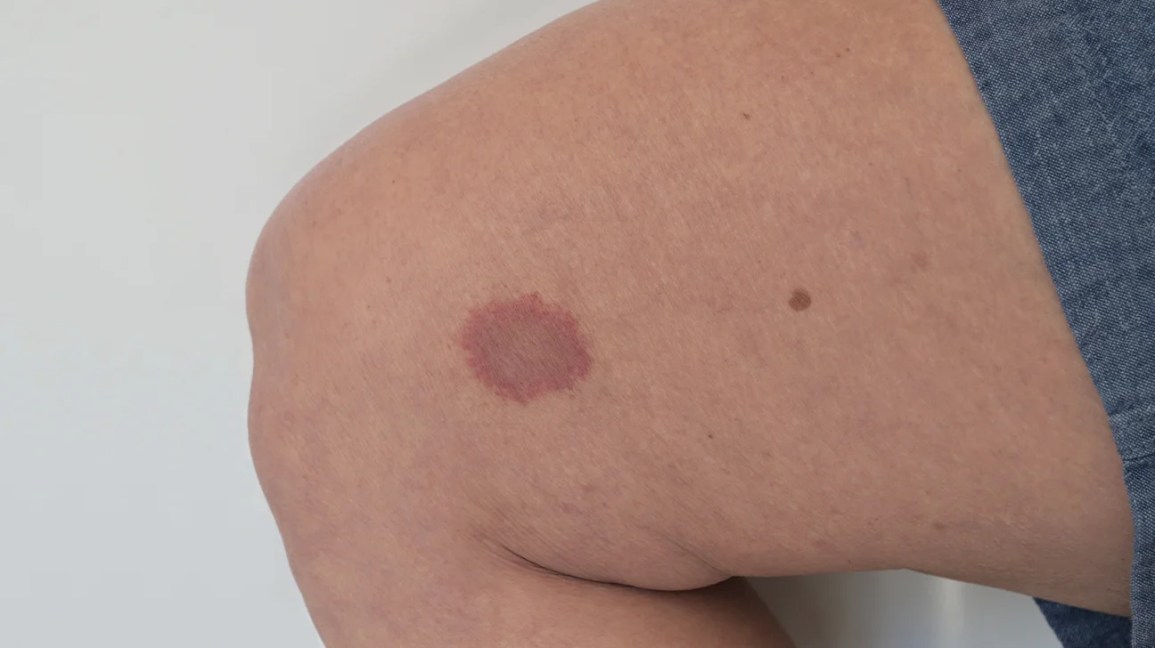 horsefly bite