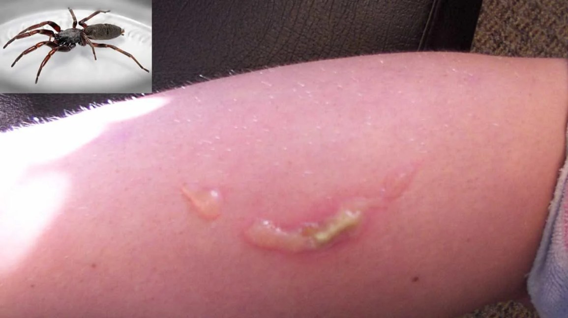 white tailed spider bite