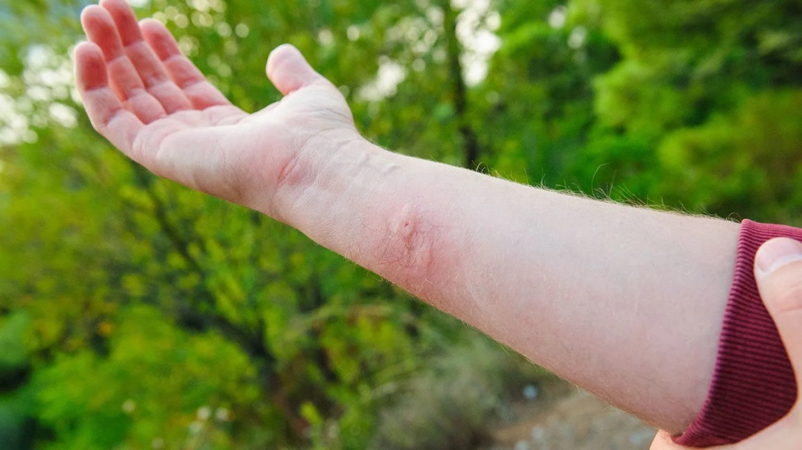 yellow jacket sting on forearm